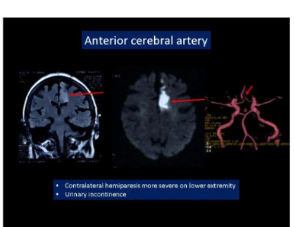 Fig 5: Cerebral infarct in the territory of the anterior cerebral artery