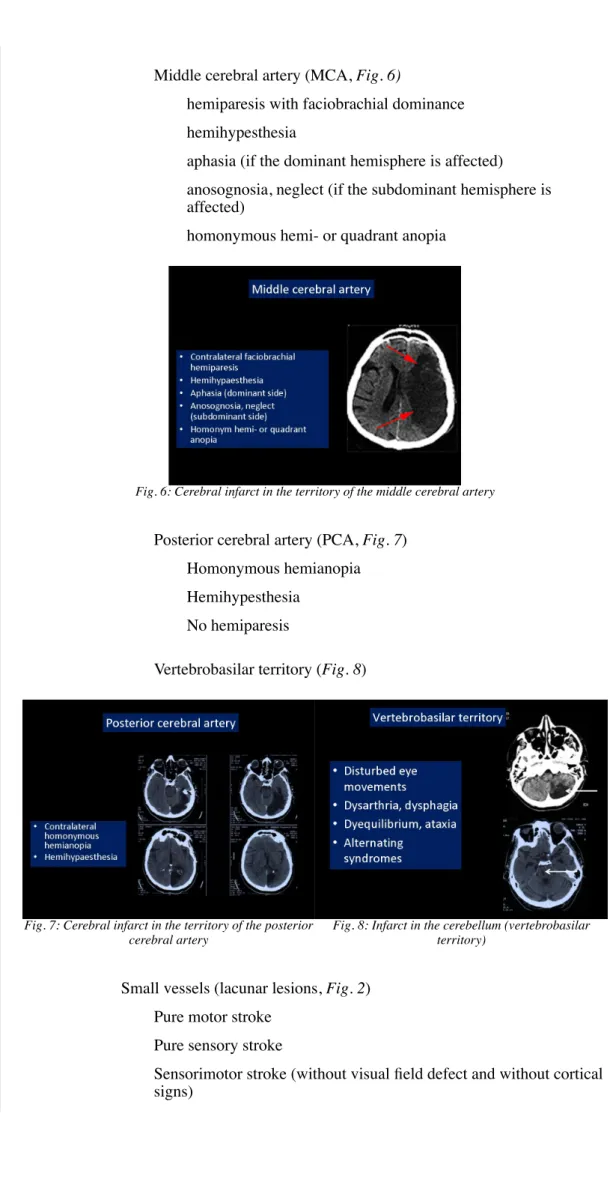 Fig. 6: Cerebral infarct in the territory of the middle cerebral artery