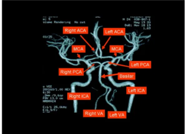Fig. 11: Major types of stroke. Ischemic stroke, intracerebral hemorrhage and subarachnoid hemorrhage