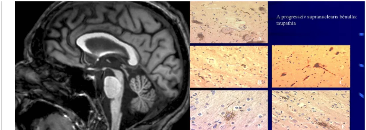 Fig. 5: MRI in PSP: mesencephalon atrophy– colibri or penguin’s sign