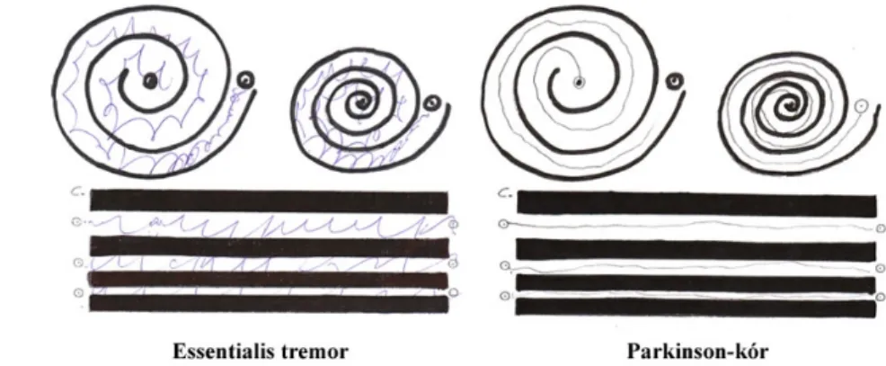 Fig. 1: Drawing of an Archimedes spiral. Due to the kinetic tremor in essential tremor, the patient draws a wavy line