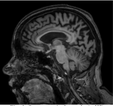 Fig. 1: Severe cortical atrophy in HD