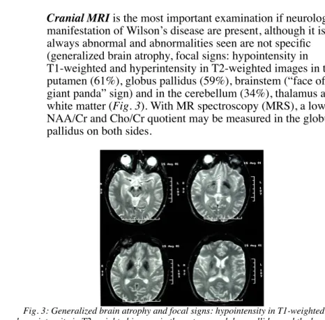 Fig. 3: Generalized brain atrophy and focal signs: hypointensity in T1-weighted and hyperintensity in T2-weighted images in the putamen, globus pallidus and the brainstem
