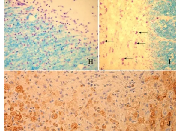 Fig. 5: Multiple sclerosis – pathology