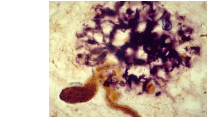 Fig. 4: Histological changes in Alzheimer's disease. Neurofibrillary tangles are marked by brown, while senile plaques by purple colors