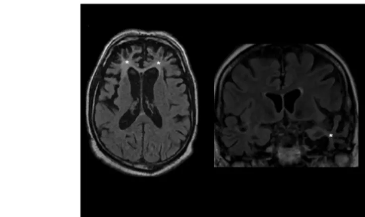 Fig. 14: Severe atrophy of the frontal lobes and the left temporal lobe (marked with stars) in a patient with FTD (MRI, FLAIR images)