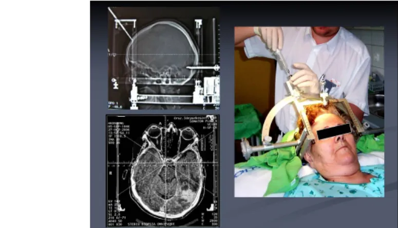 Fig. 8: Stereotactic biopsy. The coordinates are calculated by the CT images and the biopsy is being carried out.