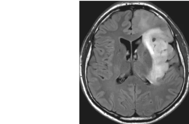 Fig. 9: 28-year-old male patient. Low grade (A2) astrocytoma, located in the left temporal region, showing infiltrative growth, causing no space-occupying effect