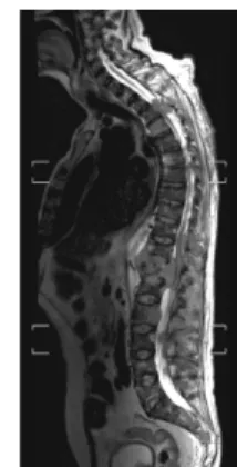 Fig. 24: Meningioma almost completely filling the thoracic spinal canal, causing spinal compression (A)