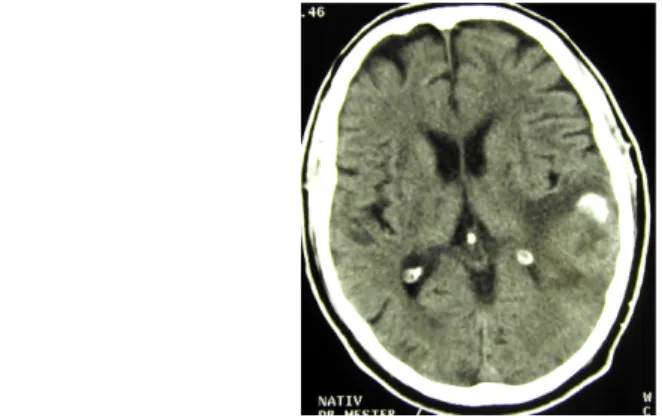 Fig. 12: Oligodendroglioma, non-enhanced CT scan. The tumor is located in the left posterior temporal lobe, and contains calcification, which is also hyperdense in non-enhanced scans.