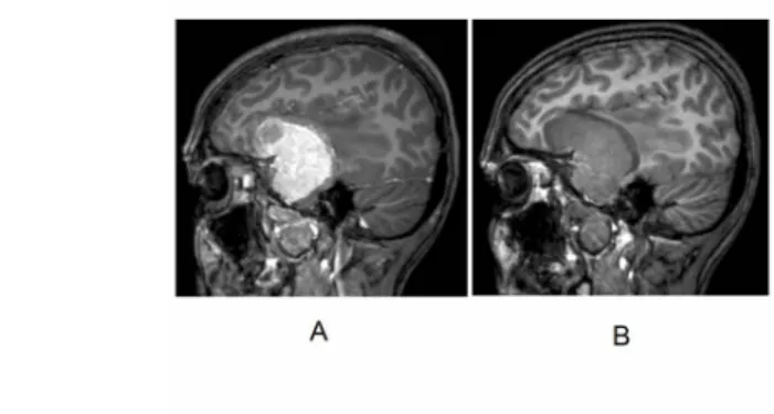 Fig. 15: 37-year-old woman. Meningioma originating on the skull base in contrast enhanced (A) and non-enhanced (B) T1-weighted MRI images.