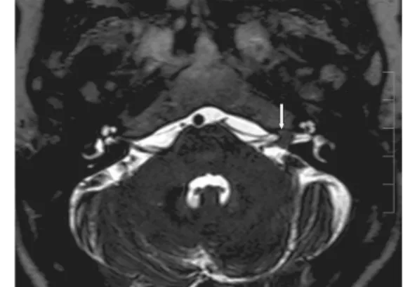 Fig. 17: A 70-year-old female patient. Left-sided large vestibular schwannoma. In  contrast-enhanced T1-weighted images, the narrow initial