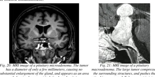 Fig. 21: MRI image of a pituitary macroadenoma. The large tumor compresses