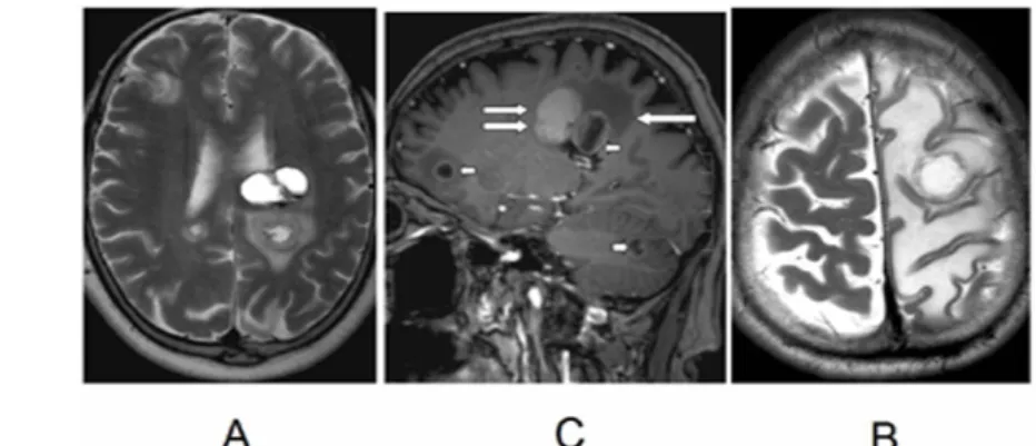 Fig. 22: Brain metastases. In images A and B, multiple hemispheric and cerebellar metastases are seen, with hemorrhage within the tumor (double arrow)
