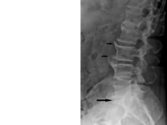 Fig. 1: Discal herniation suggested only by the decrease of the gap between the two adjoining vertebrae on X-ray image