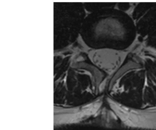 Fig. 5: Spina bifida and meningocele at the level of L4 vertebra on MRI