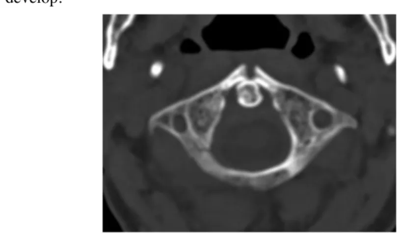 Fig. 7: C1 fracture on axial CT scan