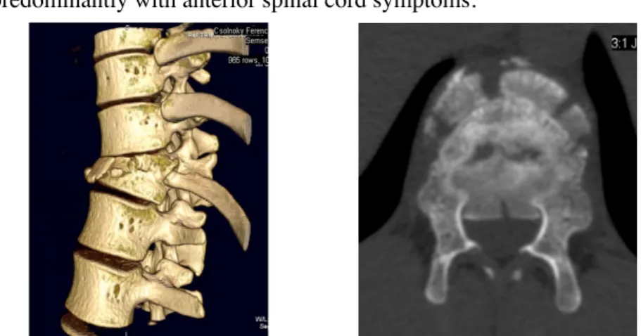 Fig. 9: 3D reconstruction of an A type fracture of the Th12 vertebra on CT scan