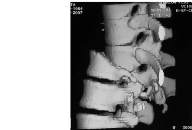Fig. 12: L1 fracture with dislocation on 3D reconstructed CT scan