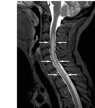Fig. 17: Extensive inflammation of the spinal cord due to Devic’s disease on MRI