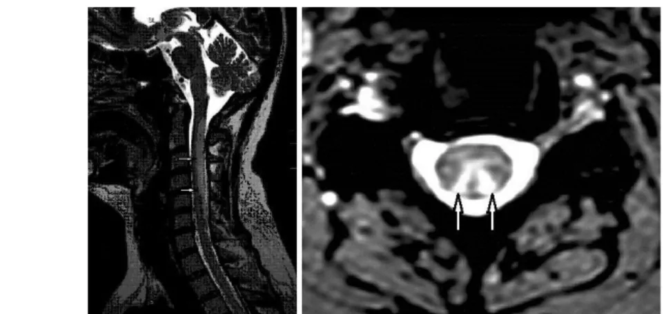 Fig. 18: MRI image in subacute combined degeneration: a long high-intensity spinal lesion is seen in the dorsal column on T2-weighted image