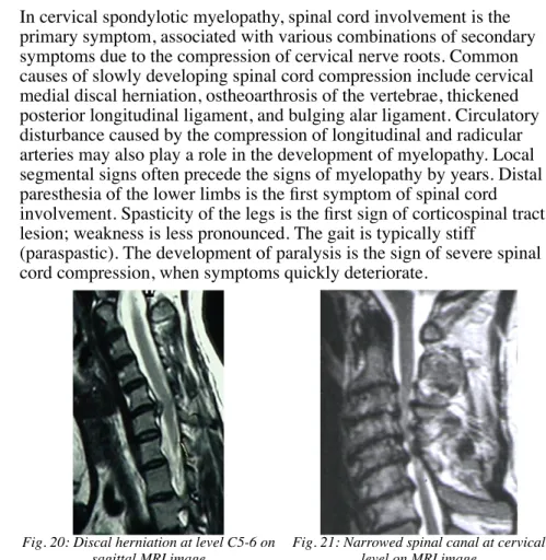Fig. 20: Discal herniation at level C5-6 on sagittal MRI image