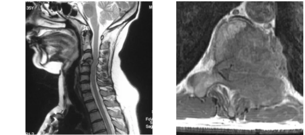 Fig. 25: Pathological fracture of C4 vertebra due to breast cancer metastasis on sagittal MRI