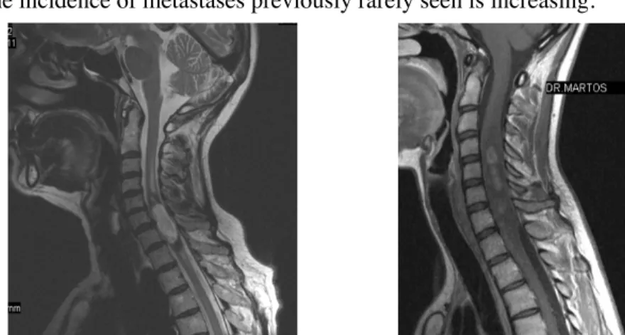 Fig. 30: Intramedullary ependymoma at C5-6 level on sagittal MRI image