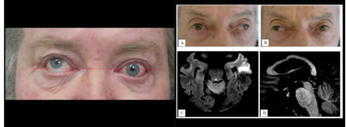 Fig. 3: “skew deviation” Fig. 4: internuclear ophthalmoplegia
