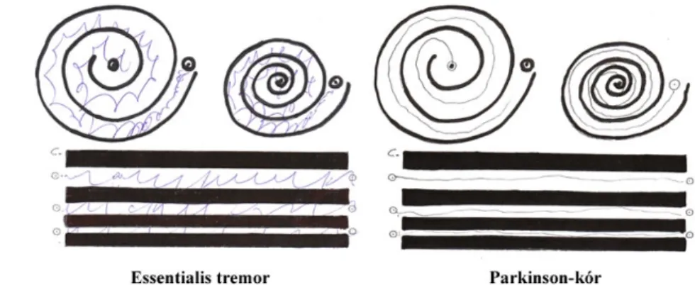 Kézírás vizsgálata, Archimedes spirál rajzoltatása (1. ábra) a tremor kinetikus komponensét mutatja ki, szemben a Parkinson-kórban megjelenő remegéssel, mely az akaratlagos mozgás alatt megszűnik.