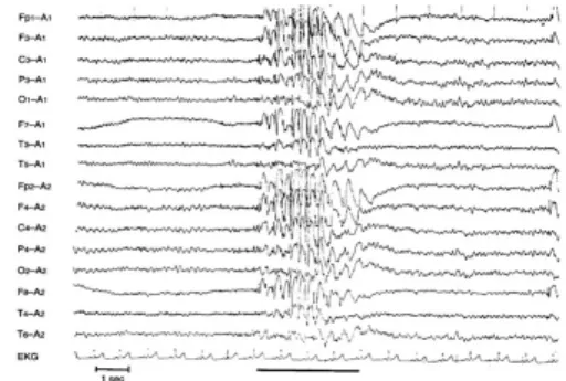 8. ábra: Myoklónus epilepsziában többestüske mintázat jelenik meg