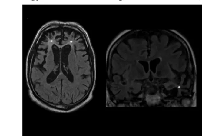 14. ábra: A frontális lebenyek kétoldali és a bal temporális lebeny bal oldali (csillagokkal jelölve) súlyos atrófiája frontotemporális demenciában (FLAIR súlyozott MRI képek)