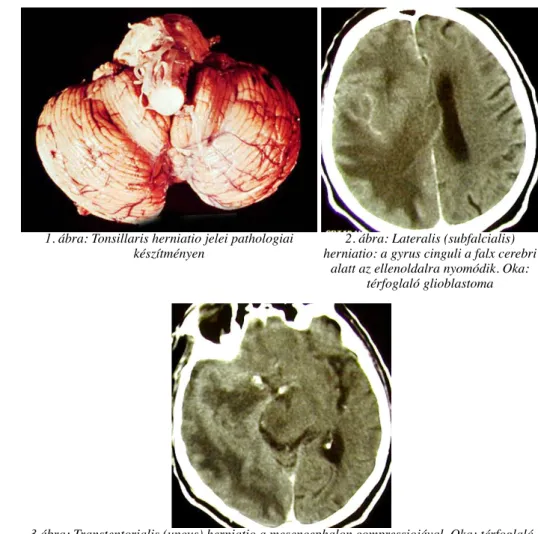 1. ábra: Tonsillaris herniatio jelei pathologiai készítményen