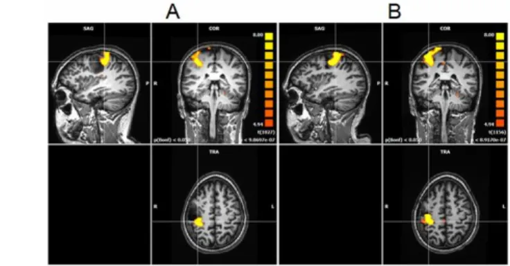 1. ábra: Elokvens területek meghatározása fMRI-vel (BOLD technika)