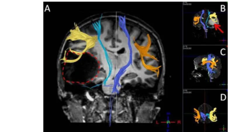 2. ábra:Nagyméretű, erősen térfoglaló bal temporalis ganglioglioma által okozott változások az idegpályák lefutásában