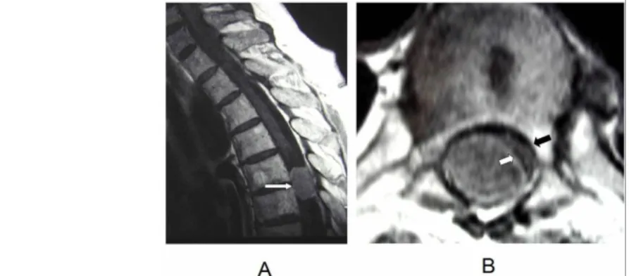 16. ábra: A gerinccsatornát szinte teljesen kitöltő, spinális kompressziót okozó meningeoma a háti szakaszon (A).