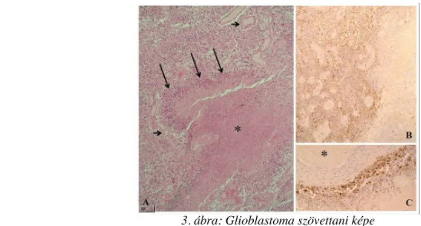 3. ábra: Glioblastoma szövettani képe