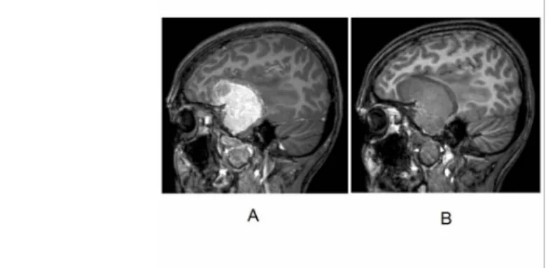7. ábra: 37 éves nőbeteg. A koponyaalapról kiinduló meningeoma kontrasztdúsított (A) és natív (B) T1 súlyozott MR képei.