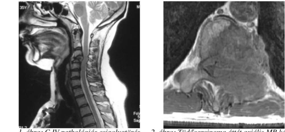 1. ábra: C IV pathológiás csigolyatörés (emlőcarcimoma áttét) sagittalis MR képen