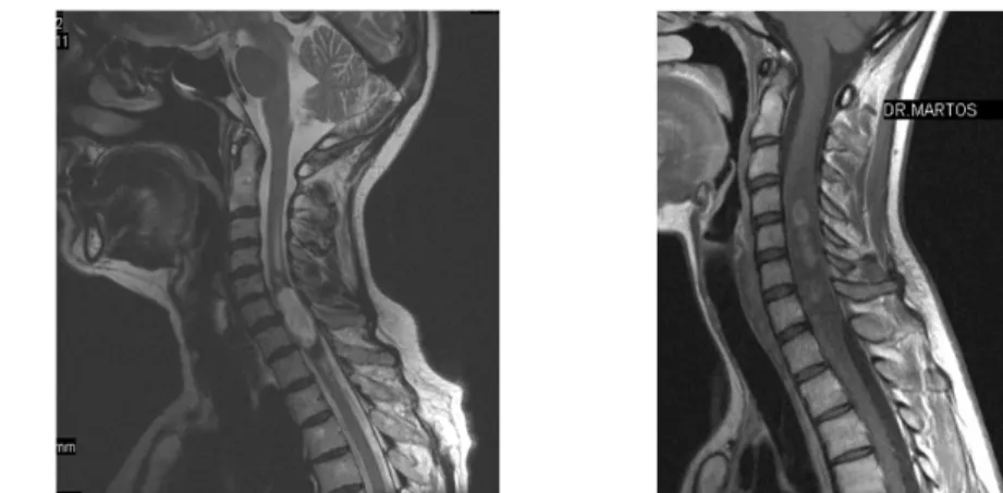 5. ábra: Neurinoma coronális MR képeken a felső thoracális szakaszon