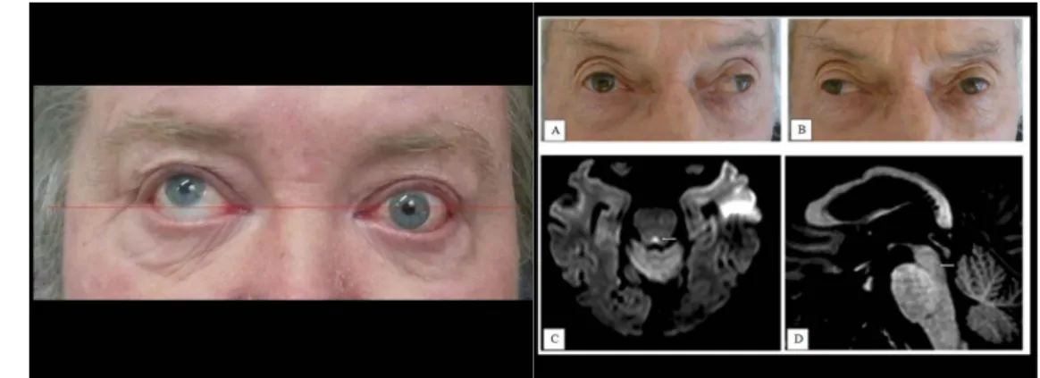 3. ábra: „Skew deviation” 4. ábra: Internuclearis ophthalmoplegia