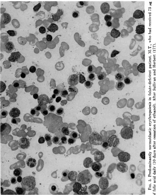 FIG. 5. Predominantly normoblastic erythropoiesis in folate-deficient patient, M.T., who had received 75 Mg  of folic acid daily (10 days after cessation of ethanol)