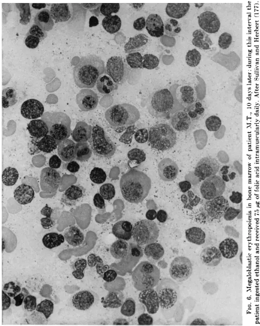 FIG. 6. Megaloblastic erythropoiesis in bone marrow of patient M.T., 10 days later; during this interval the  patient ingested ethanol and received 75 μg of folic acid intramuscularly daily