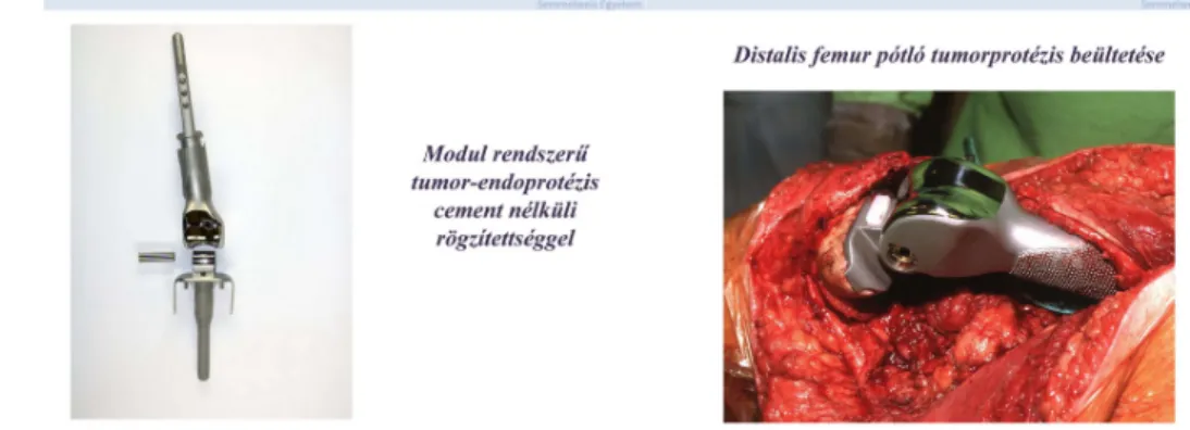 3. ábra: Modul rendszerű tumor-endoprotézis cement nélküli rögzítettséggel.