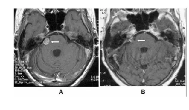 6. ábra: Jobb oldali vestibularis schwannoma kontrasztanyagos MR képei stereotaxiás sugrsebészeti kezelés előtt (A) és két évvel utána.