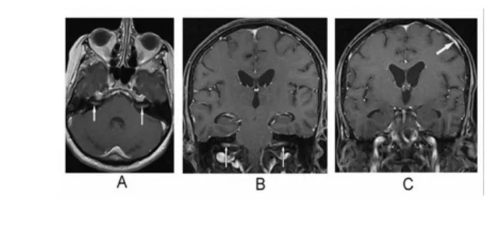 9. ábra: A korábban készült koponya MR képeket áttekintve a mindkét oldalon a nervus facialis mentén, a belső hallójáratokban (A, B) és a konvexitást kísérő agyhártyán (C)