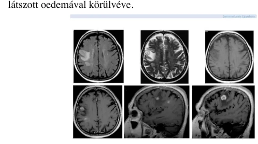 1. ábra: MR felvételeken a jobb féltekében többgócú, jelentős oedemával körülvett tumor látszik, mely a kontrasztos képeken (alsó sor) halmozást mutat.