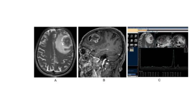 5. ábra: Bal oldali frontalis metasztázis MR képei. A tumort kiterjedt perifocalis oedema veszi körül (A), gyűrűszerű kontrasztanyag-halmozás látható (B)