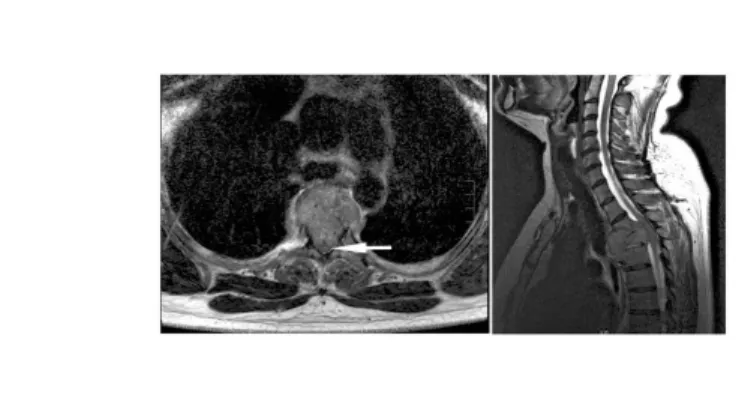 1. ábra: Az MR felvételeken megfigyelhető, hogy a thoracalis VI. csigolya tumorosan átalakult