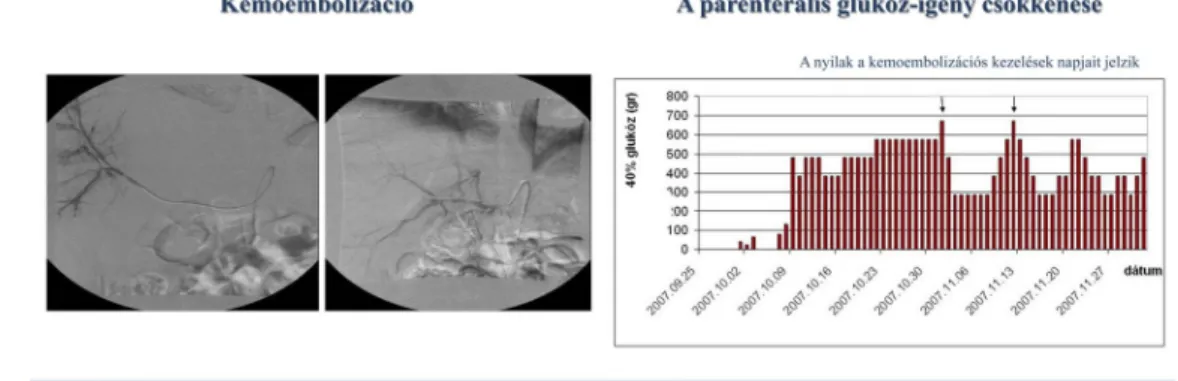 ábra - a nyilak a kemoembolizációs kezelések napjait jelzik).